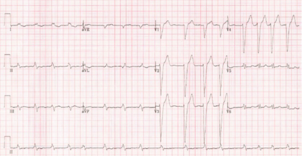 atrial_fibrillation_img_01