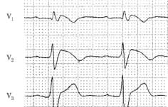 brugada_img_01