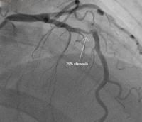 coronary_artery_stenting_img_01