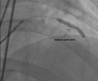 coronary_artery_stenting_img_02