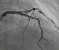 coronary_artery_stenting_img_03