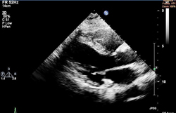 ECHOCARDIOGRAM OF A NORMAL HEART Image