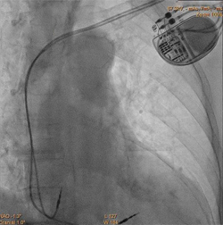 permanent_pacemaker_implantation_img_02