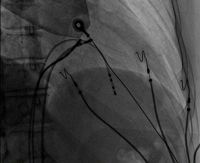 radiofrequency_catheter_ablation_img_01