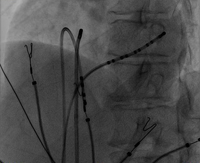 radiofrequency_catheter_ablation_img_02