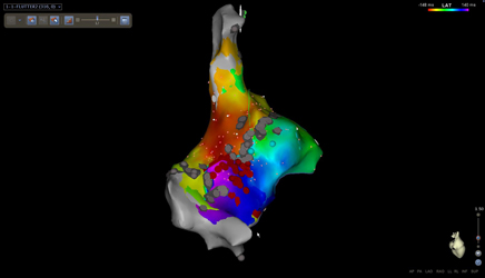 radiofrequency_catheter_ablation_img_03