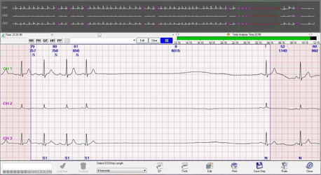 sick sinus syndrome sick sinus syndrome