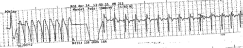 sudden_cardiac_death_img_02