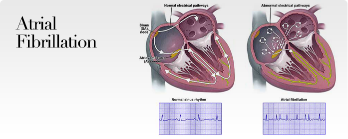 B3 afib. Atrial Fibrillation illustration. Jestar Heart Project arrhythmia
