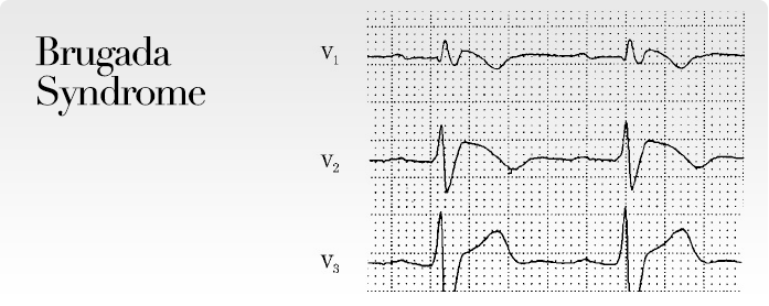 Brugada Syndrome