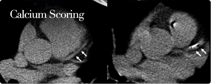 Calcium Scoring