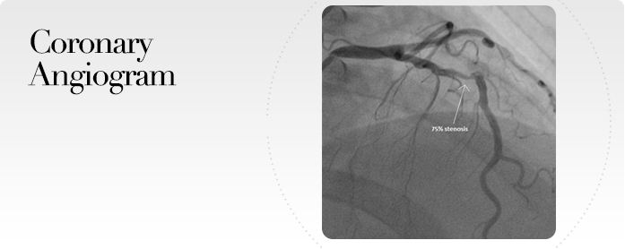 Coronary Angiography By Cardiac Catheterization