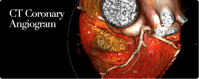CT Coronary Angiogram