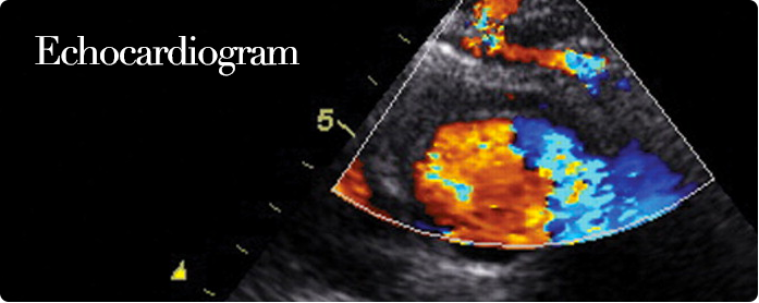 Echocardiogram or Echocardiography