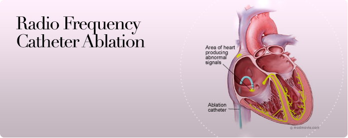 Radiofrequency Catheter Ablation