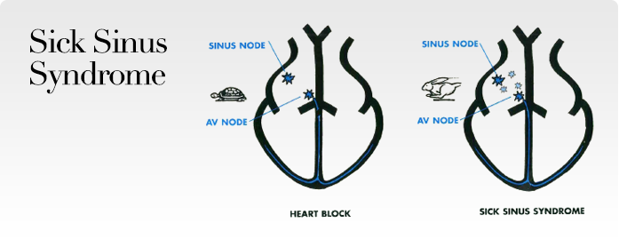 Sick Sinus Syndrome