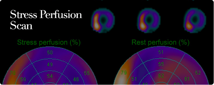 Stress Perfusion Scan