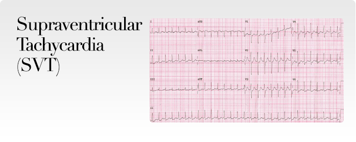 Supraventricular Tachycardia (SVT)