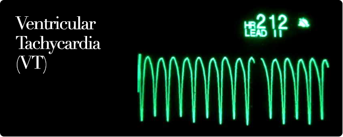 Ventricular Tachycardia (VT)